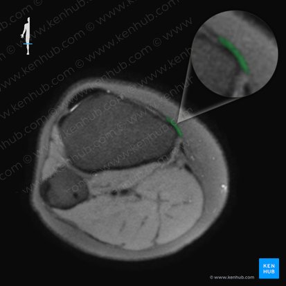 Ligamento colateral tibial de la articulación de la rodilla (Ligamentum collaterale tibiale genus); Imagen: 