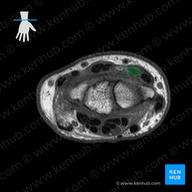 Tendon of extensor carpi radialis brevis muscle (Tendo musculi extensor carpi radialis brevis); Image: 