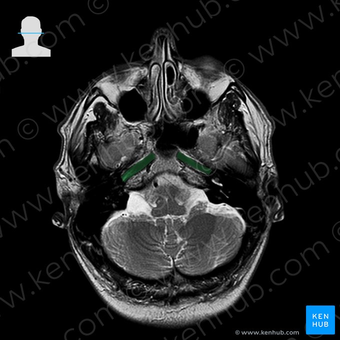 Internal carotid artery (Arteria carotis interna); Image: 