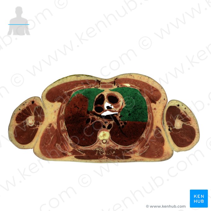 Superior lobe of lung (Lobus superior pulmonis); Image: National Library of Medicine