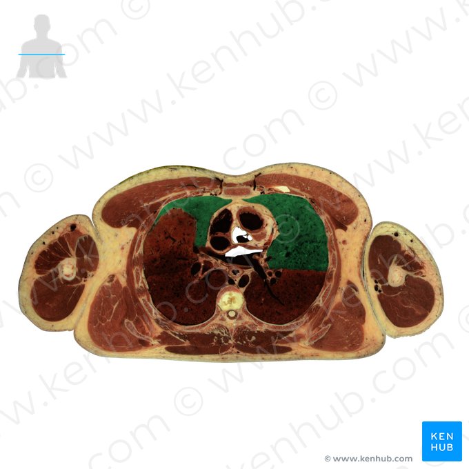 Lobo superior do pulmão (Lobus superior pulmonis); Imagem: National Library of Medicine