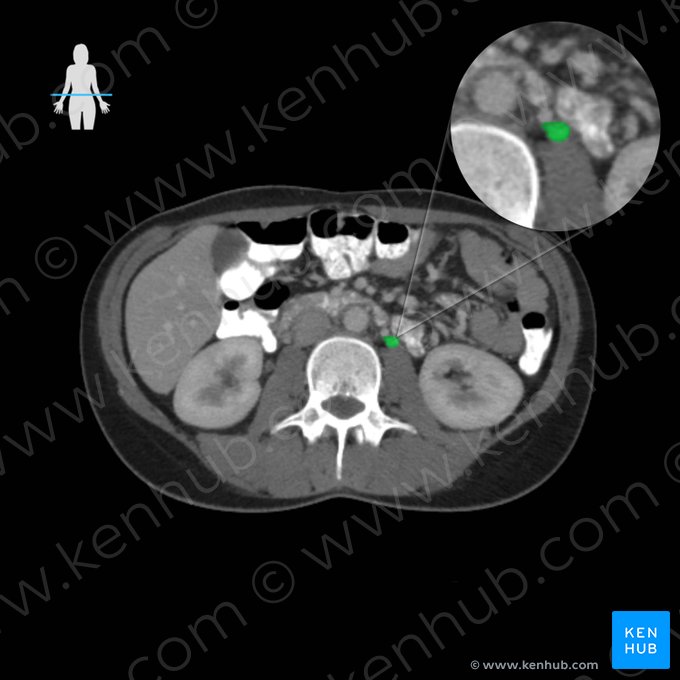 Left ovarian vein (Vena ovarica sinistra); Image: 