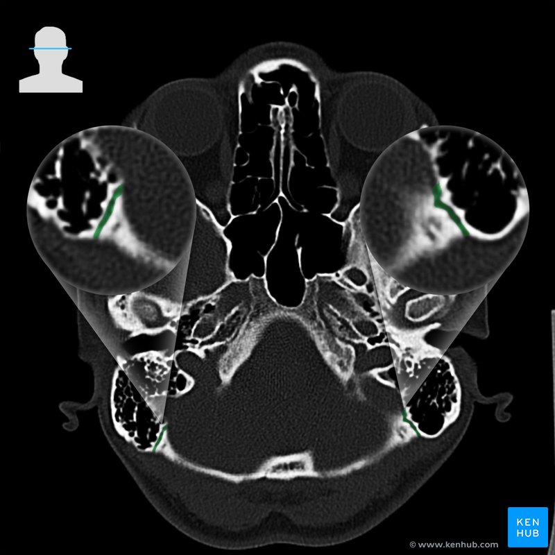 Occipitomastoid suture - axial view