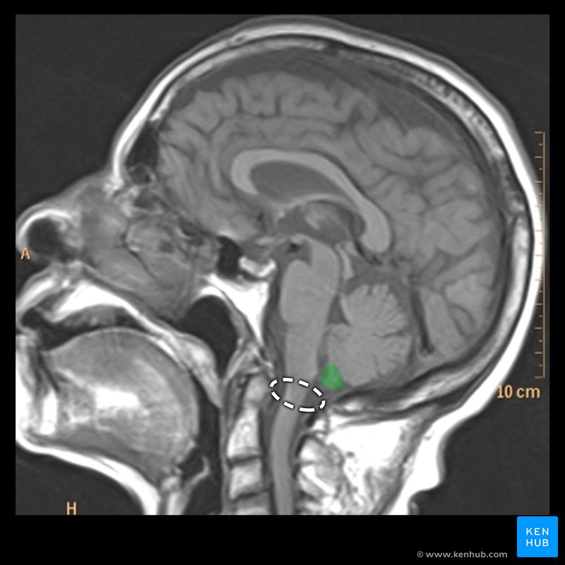 Foramen magnum and cerebellar tonsil - sagittal T1 MRI