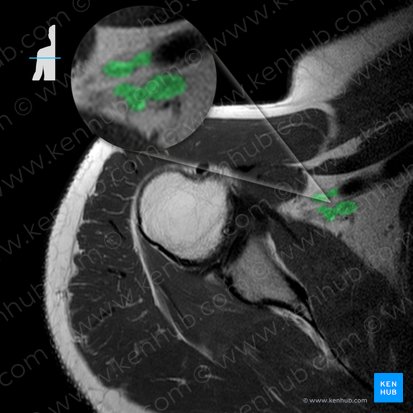 Plexus brachialis (Armgeflecht); Bild: 