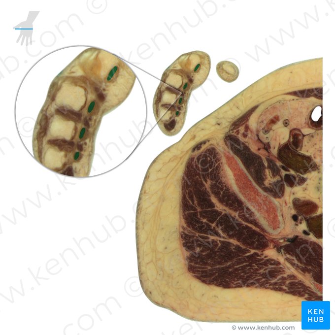 Tendons of flexor digitorum profundus muscle (Tendines musculi flexoris digitorum profundus); Image: National Library of Medicine