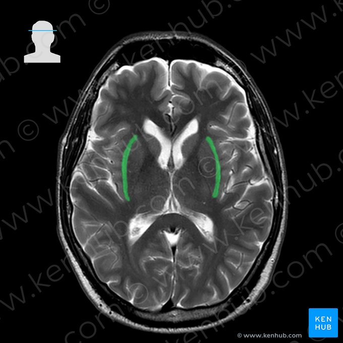 Cápsula externa (Capsula externa); Imagen: 