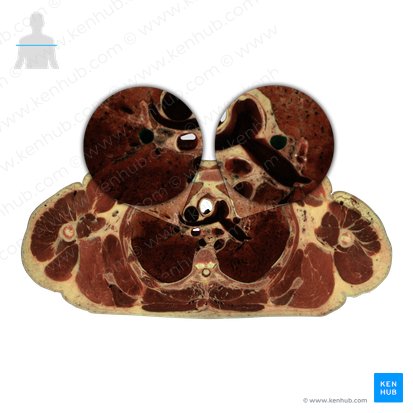 Veias pulmonares (Venae pulmonales); Imagem: National Library of Medicine