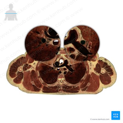 Pulmonary veins (Venae pulmonales); Image: National Library of Medicine