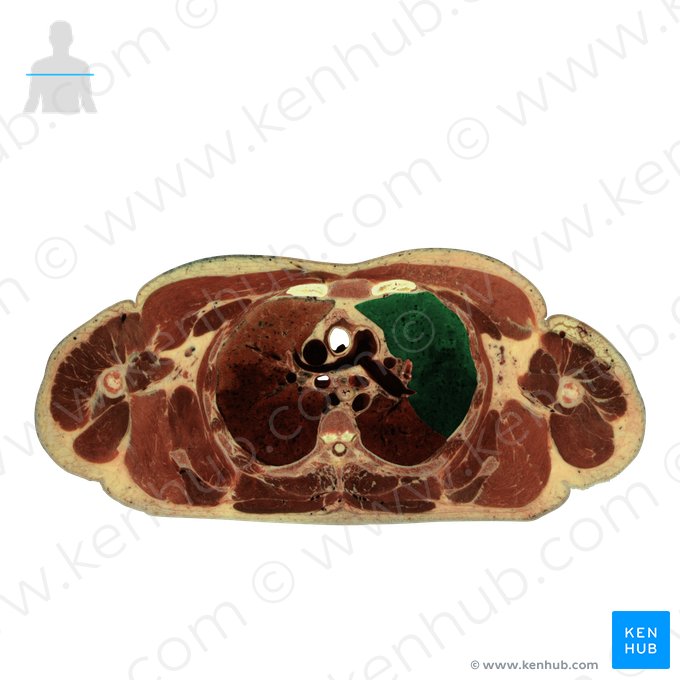 Lobus superior pulmonis sinistri (Oberlappen der linken Lunge); Bild: National Library of Medicine