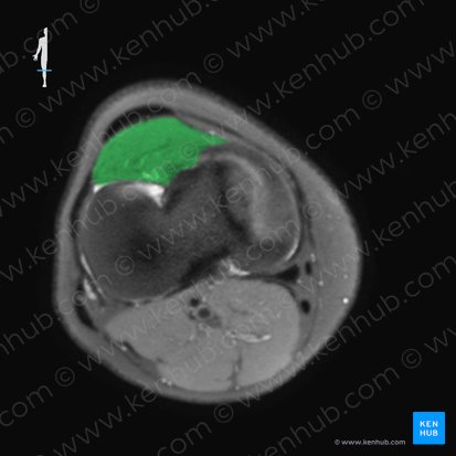 Corpus adiposum infrapatellare (Hoffa-Fettkörper); Bild: 
