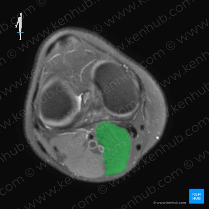 Medial head of gastrocnemius muscle (Caput mediale musculi gastrocnemii); Image: 