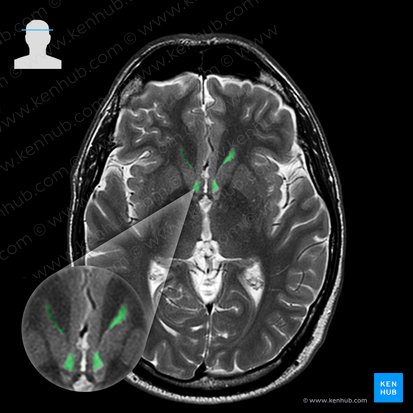 Asta frontal del ventrículo lateral (Cornu frontale ventriculi lateralis); Imagen: 