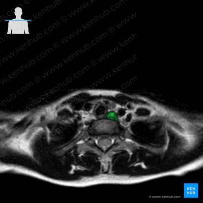 Pars cervicalis oesophagi (Halsteil der Speiseröhre); Bild: 