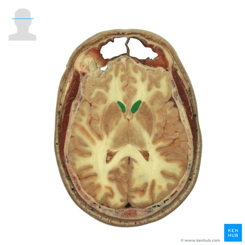 Cadaveric dissection (head of caudate nucleus) - cross-sectional view