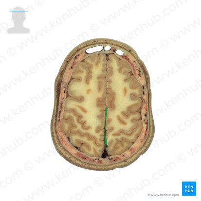 Foice do cérebro (Falx cerebri); Imagem: National Library of Medicine