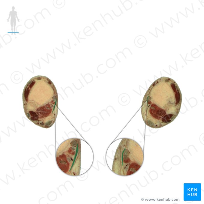 Flexor retinaculum of foot (Retinaculum flexorum pedis); Image: National Library of Medicine