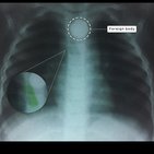 Clinical case: Button battery ingestion