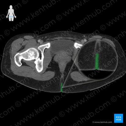 Intergluteal cleft (Crena interglutealis); Image: 