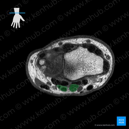 Flexor digitorum superficialis muscle (Musculus flexor digitorum superficialis); Image: 