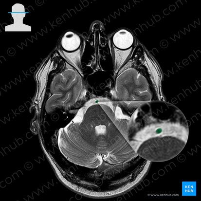 Basilar artery (Arteria basilaris); Image: 