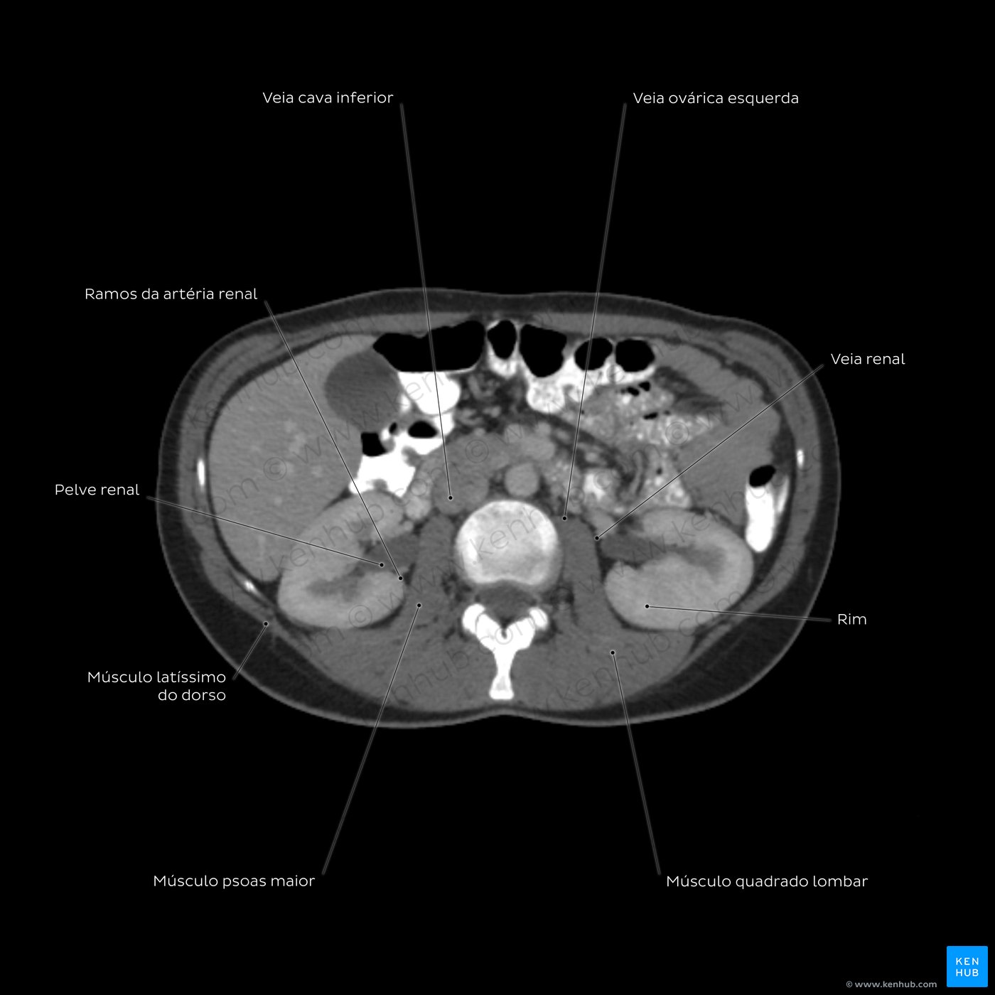 Esquema de TC abdominal ao nível de L3