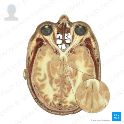 Tercer ventrículo (Ventriculus tertius); Imagen: National Library of Medicine