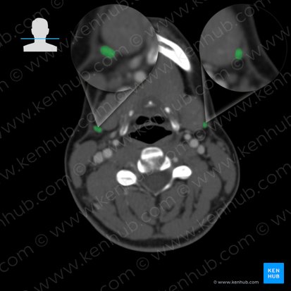 Vena jugularis anterior (Vordere Drosselvene); Bild: 