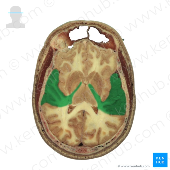 Lobo temporal (Lobus temporalis); Imagem: National Library of Medicine