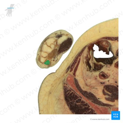 Pisiform bone (Os pisiforme); Image: National Library of Medicine