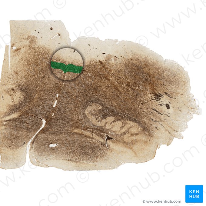 Fascículo longitudinal medial (Fasciculus longitudinalis medialis); Imagen: 