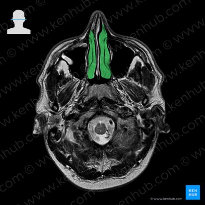 Concha nasal inferior (Concha nasalis inferior); Imagem: 