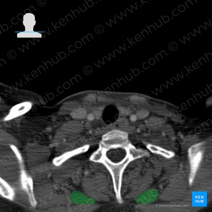 Rhomboid major muscle (Musculus rhomboideus major); Image: 