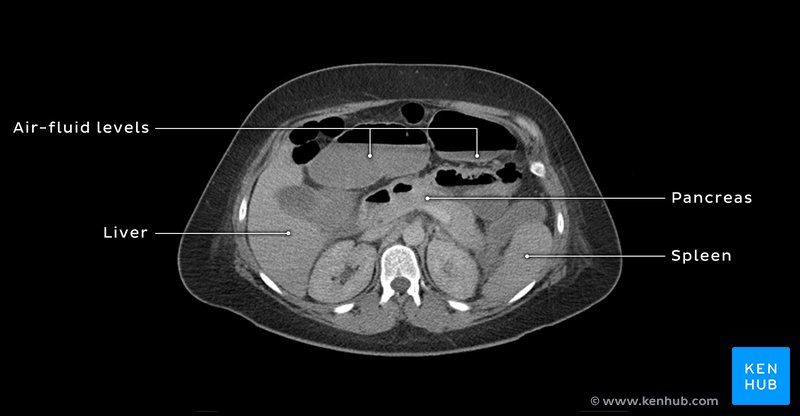 Possible pancreatitis and air-fluid levels