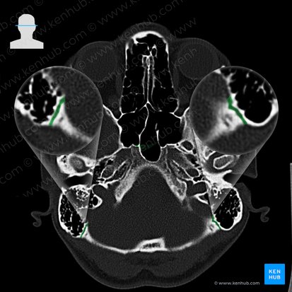Occipitomastoid suture (Sutura occipitomastoidea); Image: 