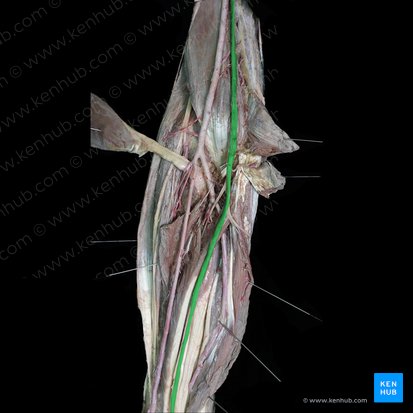 Median nerve (Nervus medianus); Image: 