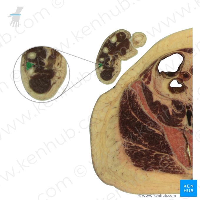 4.º músculo interósseo dorsal da mão (Musculus interosseus dorsalis 4 manus); Imagem: National Library of Medicine