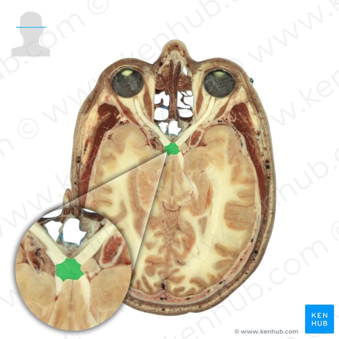 Optic chiasm (Chiasma opticum); Image: National Library of Medicine