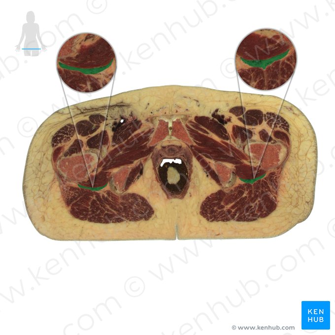 Nervo ciático (Nervus ischiadicus); Imagem: National Library of Medicine