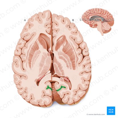 Calcarine sulcus (Sulcus calcarinus); Image: Paul Kim