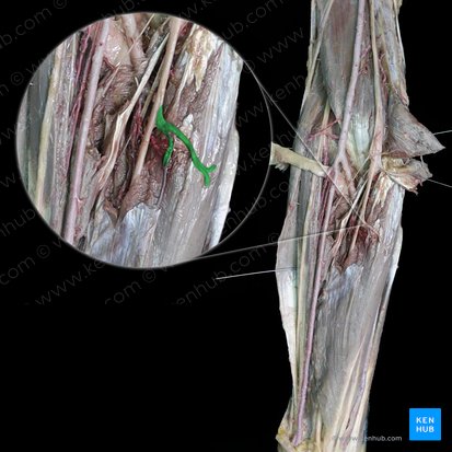 Muscular branches of median nerve to flexor digitorum superficialis muscle (Rami musculares nervi mediani cum musculus flexor digitorum superficialis); Image: 