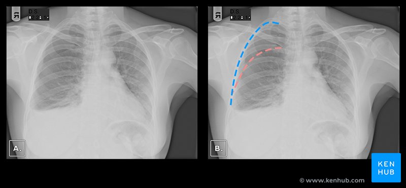 Hemothorax and pneumothorax on X-ray