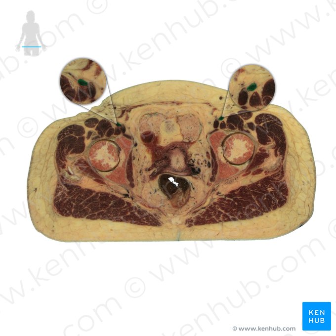 Arteria iliaca externa (Äußere Beckenarterie); Bild: National Library of Medicine