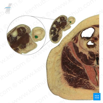 Tendão do músculo flexor longo do polegar (Tendo musculi flexoris pollicis longi); Imagem: National Library of Medicine