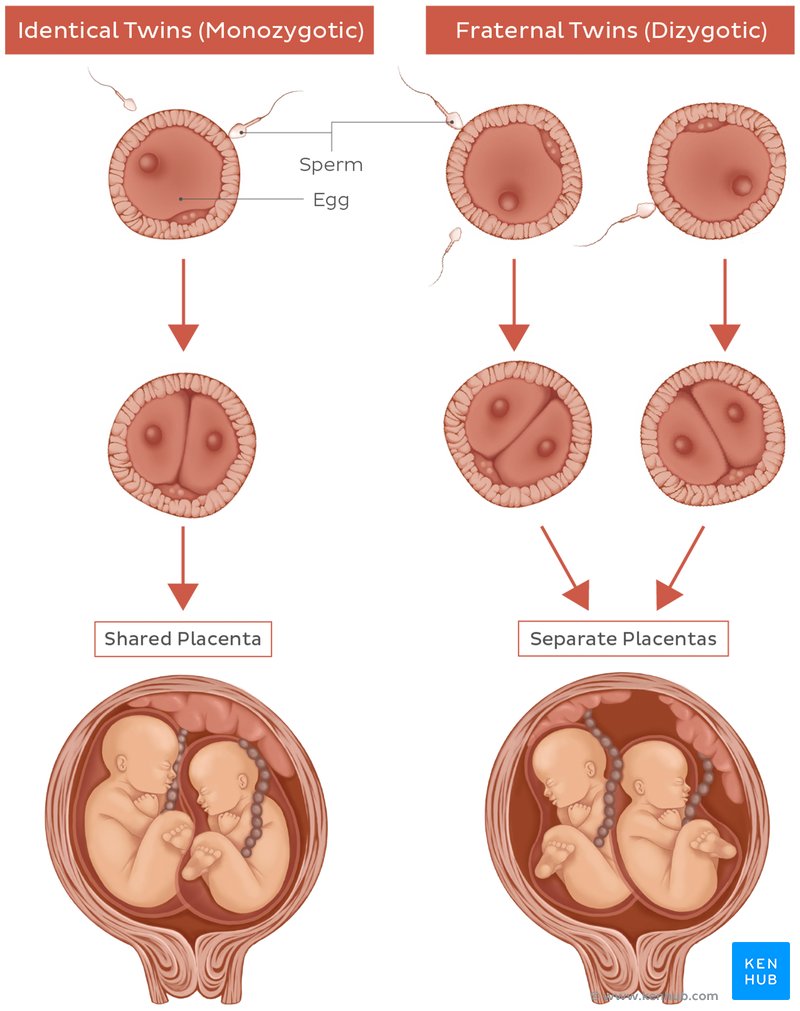 Multiple Pregnancy