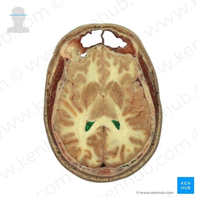 Corno occipital do ventrículo lateral (Cornu occipitale ventriculi lateralis); Imagem: National Library of Medicine