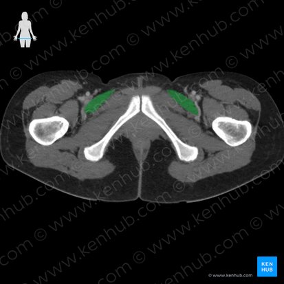 Pectineus muscle (Musculus pectineus); Image: 