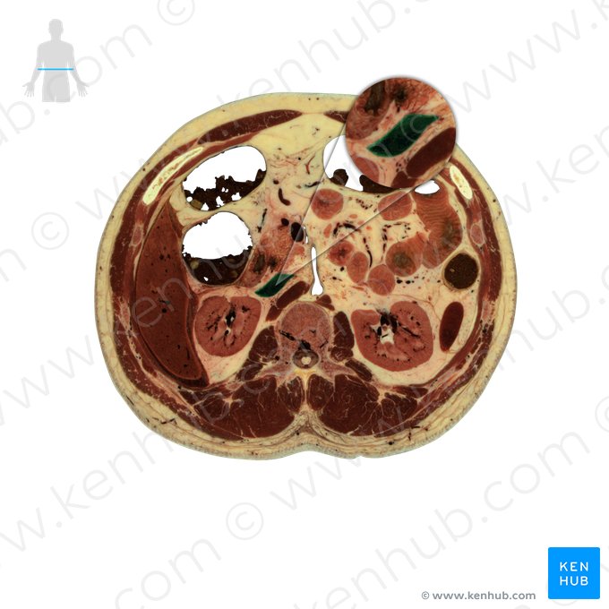 Veia cava inferior (Vena cava inferior); Imagem: National Library of Medicine