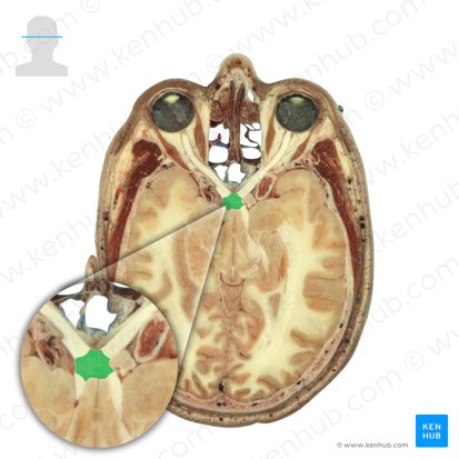 Quiasma óptico (Chiasma opticum); Imagen: National Library of Medicine