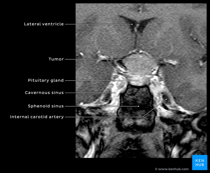 Sella turcica meningioma - Coronal T1 MRI